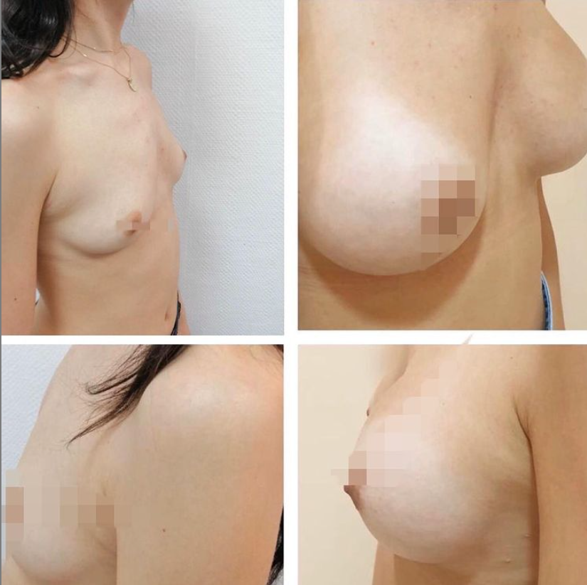 mamoplastia-aumento-2